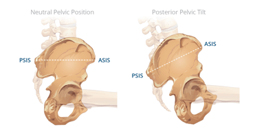 Neutral pelvic position vs posterior pelvic tilt